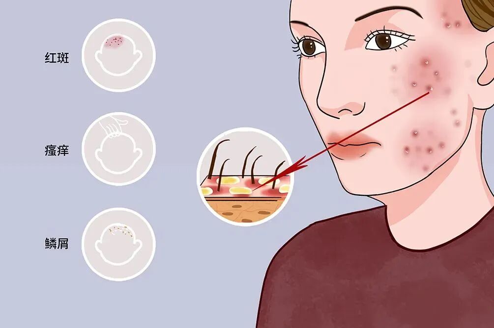 别再盲目跟风，常见的面部皮炎四大类型，治疗方式各不相同！
