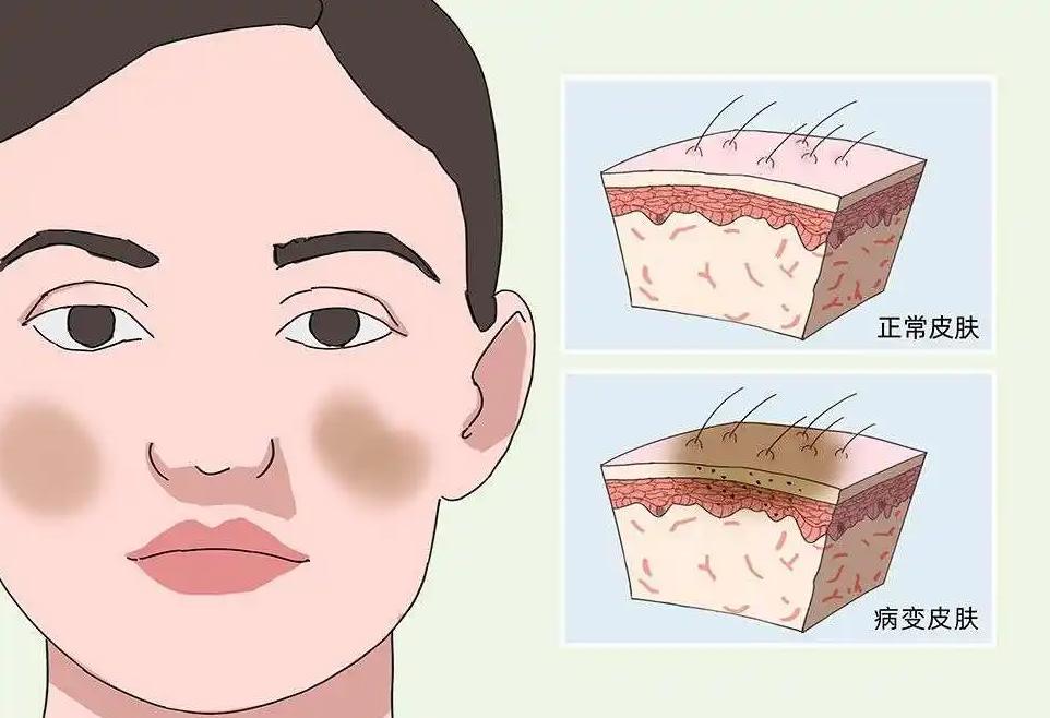 女性脸上最常见的三种色斑，皮肤科医生教你快速区分，科学解决它